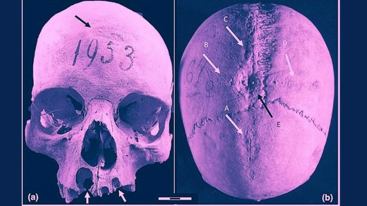 Dwie trepanacje czaszki, jedna nieudana - badania cmentarzyska Longobardów