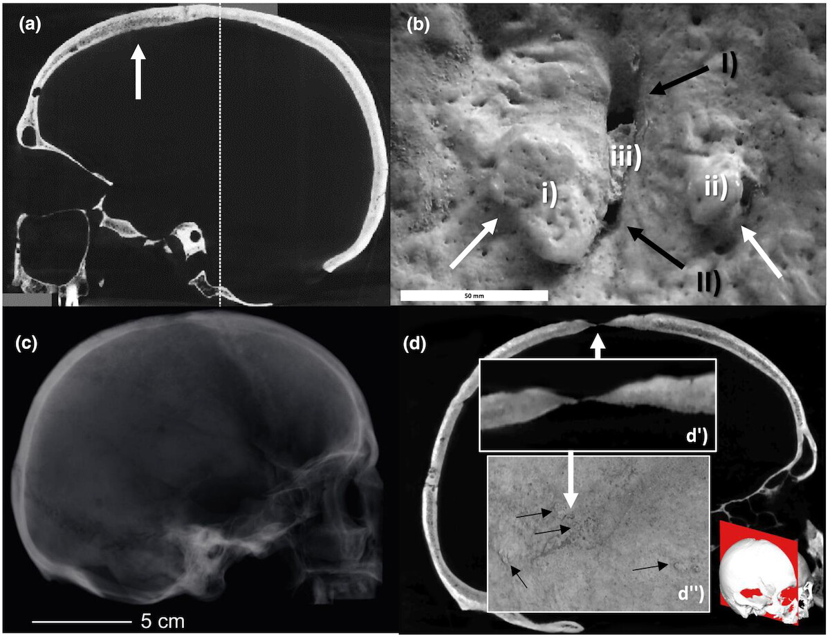 Analizy czaszki kobiety CT1953 z grobu nr 67 z cmenatrzyska Castel Trosino, Włochy (VI-VIII w.): a) tomografia komputerowa, b) powiększenie, c) zdjecie rentgenowskie, d) jego powiększenie - widoczne cienka grubość kości. Źródło:Źródło: <a href='https://onlinelibrary.wiley.com/doi/10.1002/oa.3202' rel='noopener'>International Journal of Osteoarchaeology</a>. 